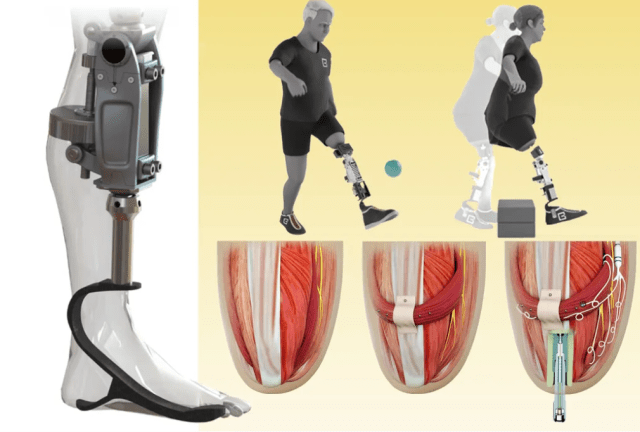 бионический коленный протез